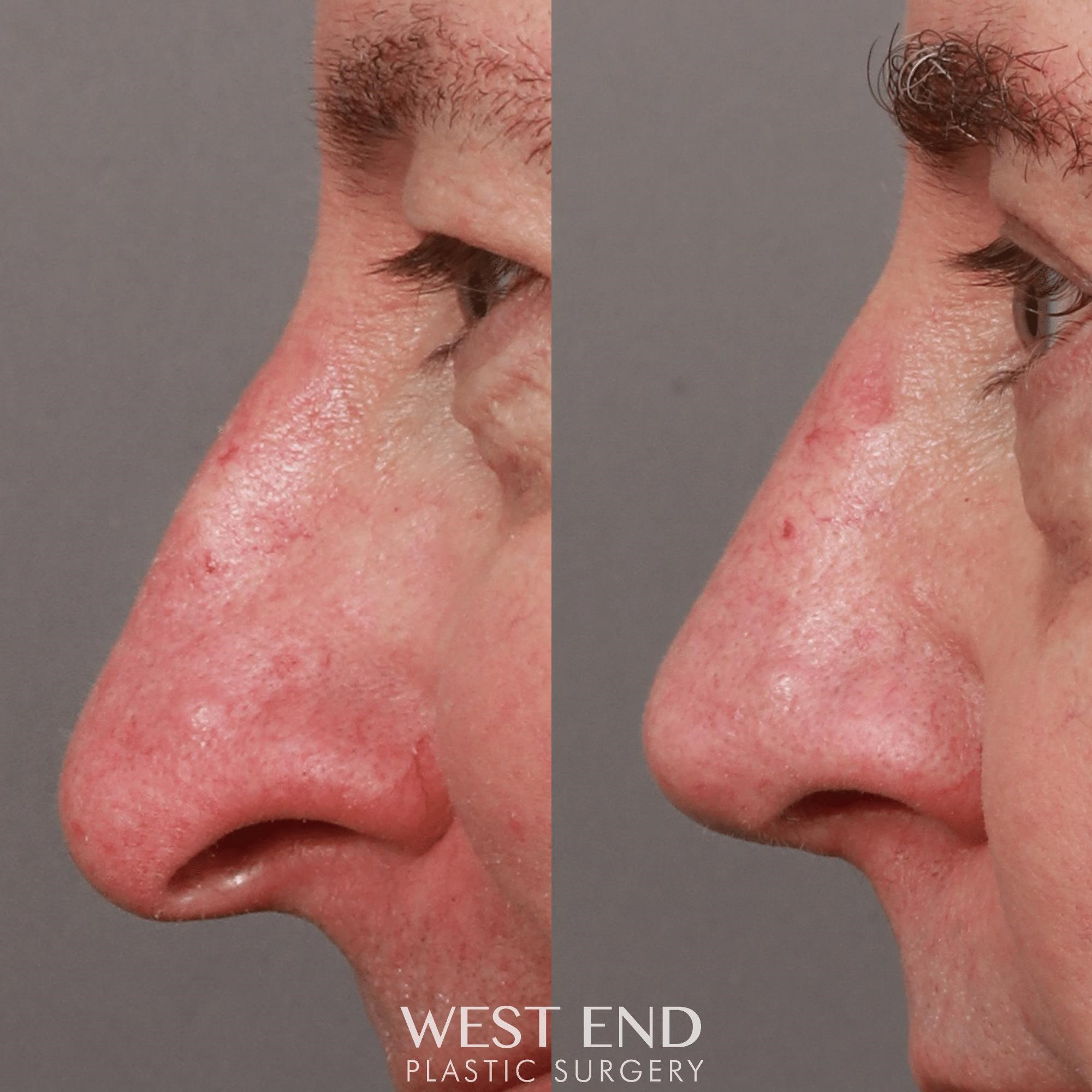 rhinoplasty experts