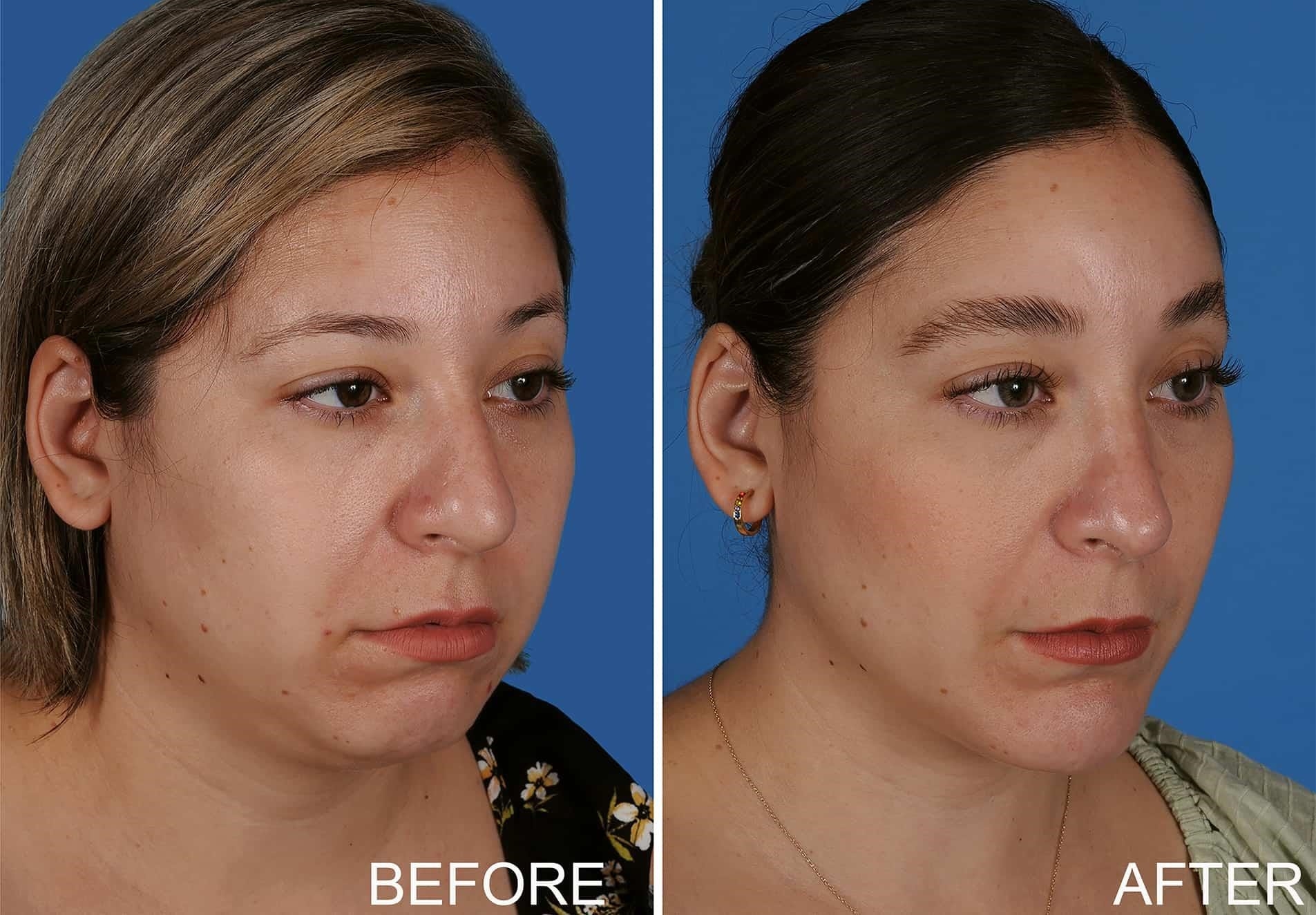 rhinoplasty experts