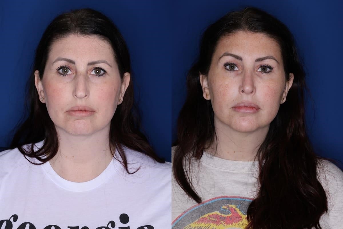 rhinoplasty experts